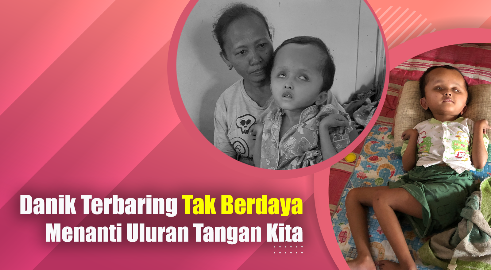 Kepala Danik Semakin Membesar karena Hidrosefalus