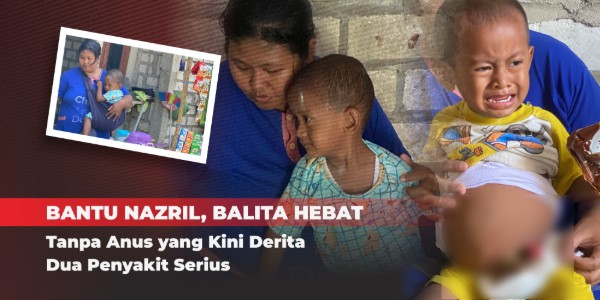 Bantu Nazril (2 Thn) Lawan Atresia Ani & Komplikasi