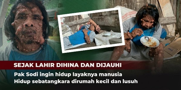 Pak Sodi Sakit Kulit Langka & Sering Dihina "Monster"